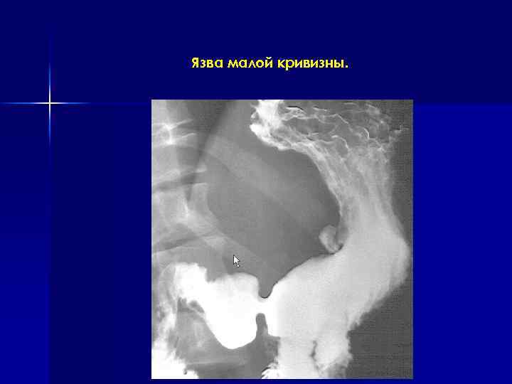 Язва малой кривизны. 