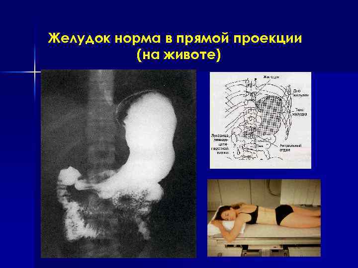 Желудок норма в прямой проекции (на животе) 