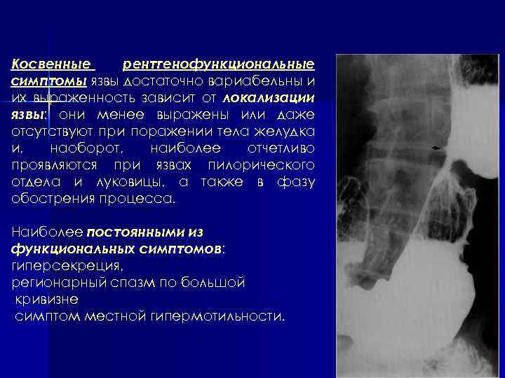 Косвенные рентгенофункциональные симптомы язвы достаточно вариабельны и их выраженность зависит от локализации язвы: они
