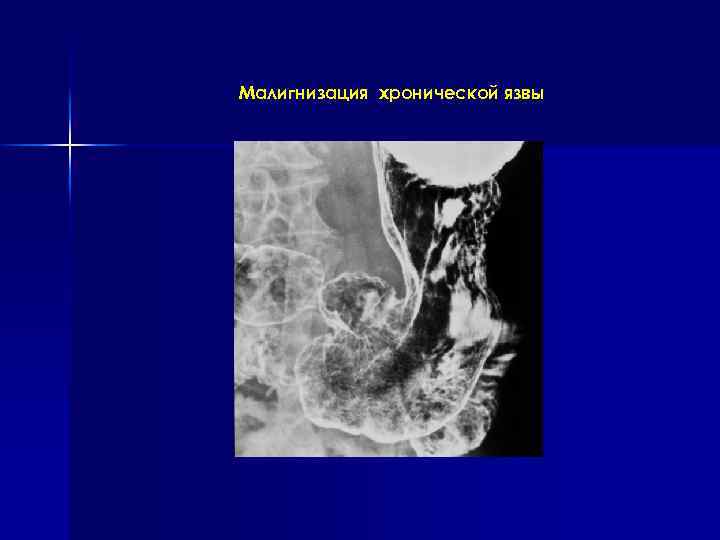 Малигнизация хронической язвы 