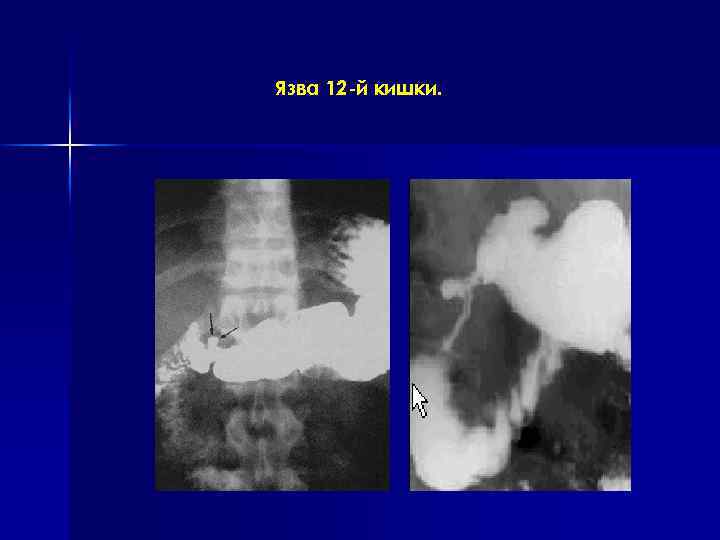 Язва 12 -й кишки. 