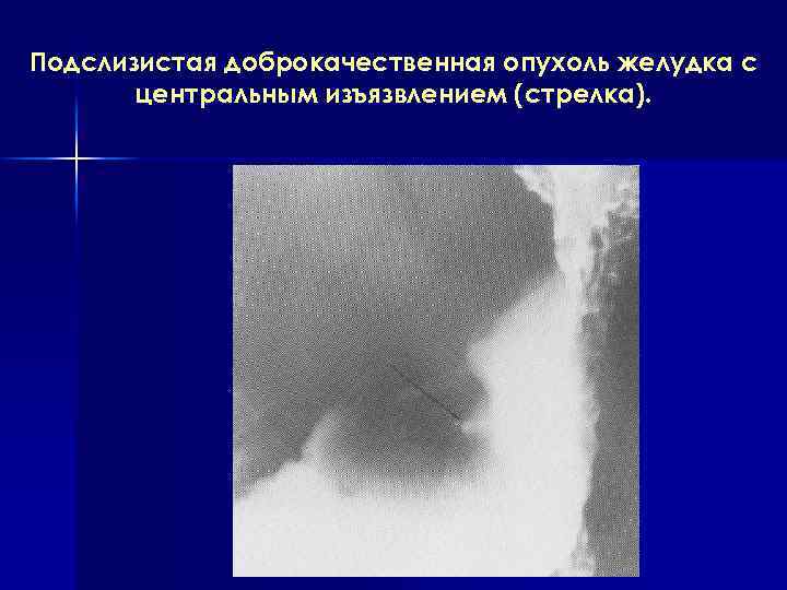 Подслизистая доброкачественная опухоль желудка с центральным изъязвлением (стрелка). 