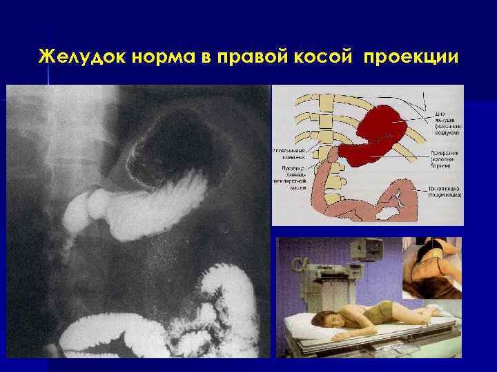 Желудок норма в правой косой проекции 