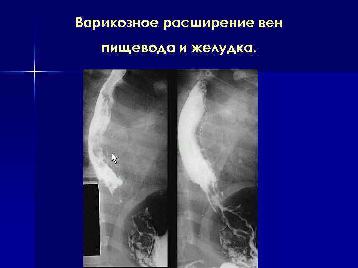 Варикозное расширение вен пищевода и желудка. 