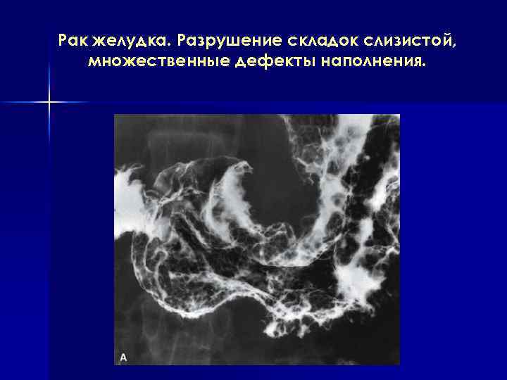 Складки слизистой. Конвергенция складок слизистой желудка это. Симптом конвергенции складок слизистой. Симптом деструкции складок слизистой.