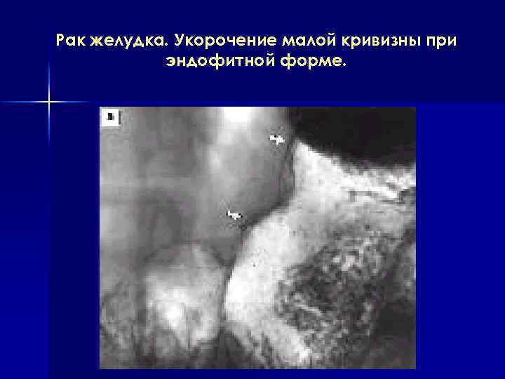 Рак желудка. Укорочение малой кривизны при эндофитной форме. 