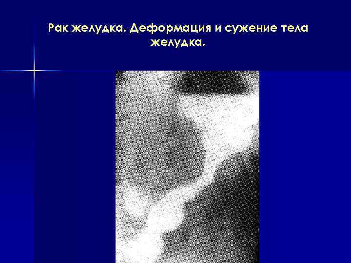 Рак желудка. Деформация и сужение тела желудка. 