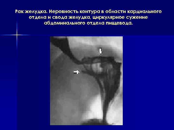 Рак желудка. Неровность контура в области кардиального отдела и свода желудка, циркулярное сужение абдоминального