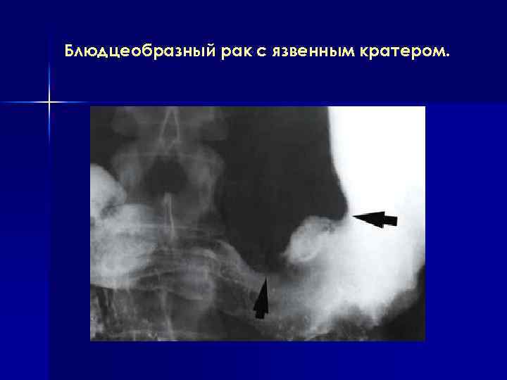 Блюдцеобразный рак с язвенным кратером. 