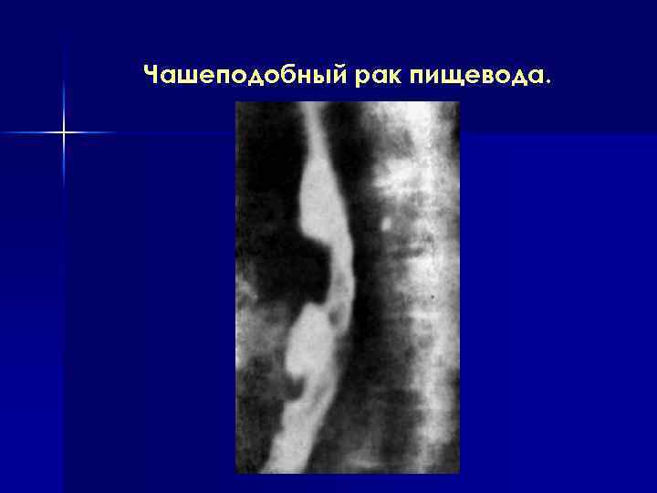 Чашеподобный рак пищевода. 