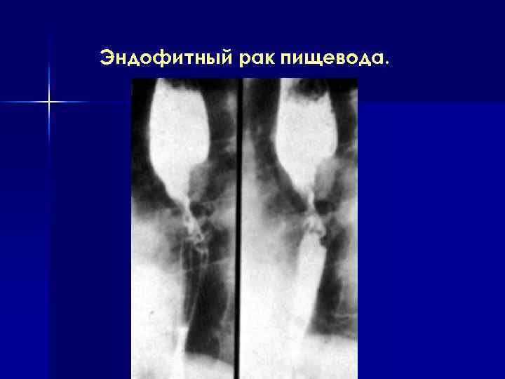 Эндофитный рак пищевода. 
