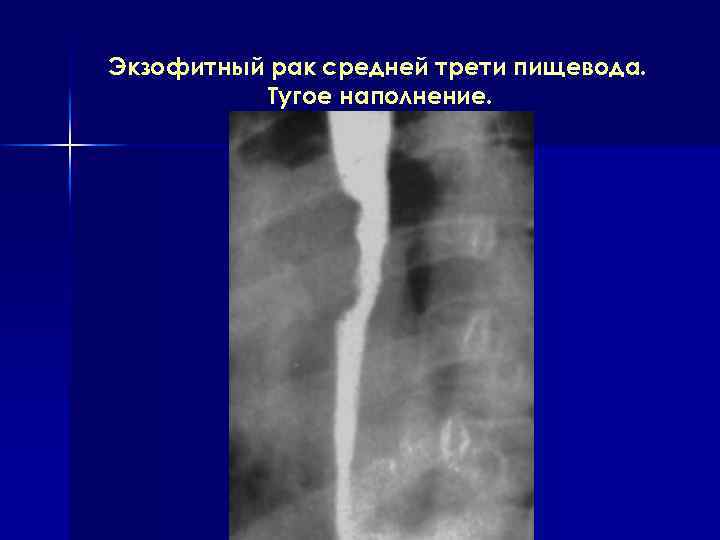 Экзофитный рак средней трети пищевода. Тугое наполнение. 