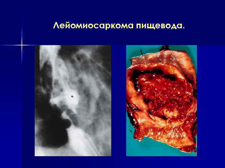 Лейомиосаркома пищевода. 