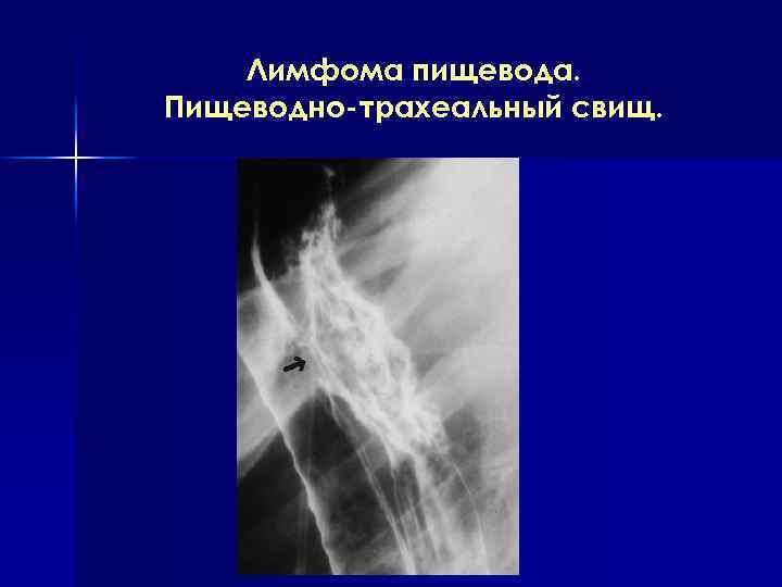 Лимфома пищевода. Пищеводно-трахеальный свищ. 
