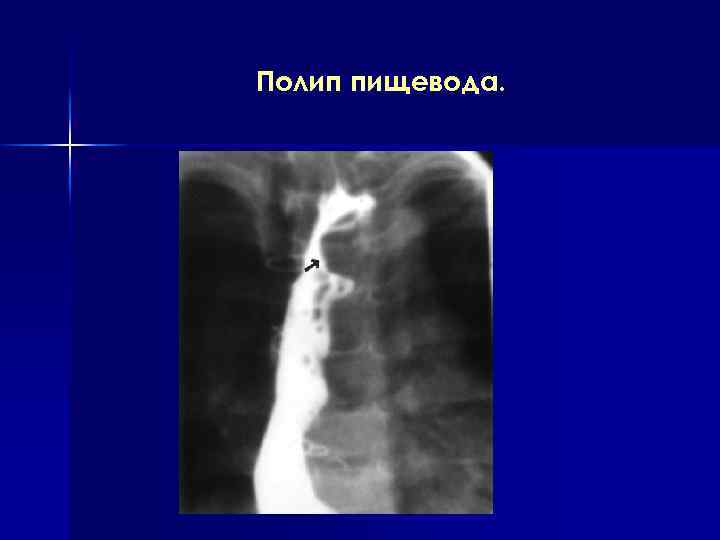 Полип пищевода. 