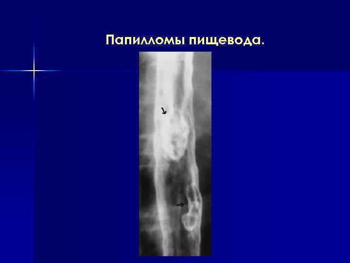 Папилломы пищевода. 
