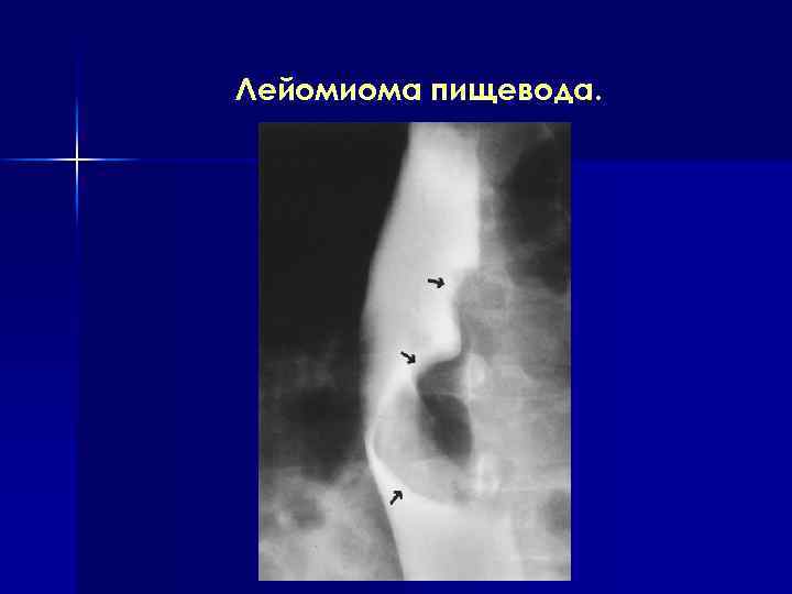 Лейомиома пищевода. 