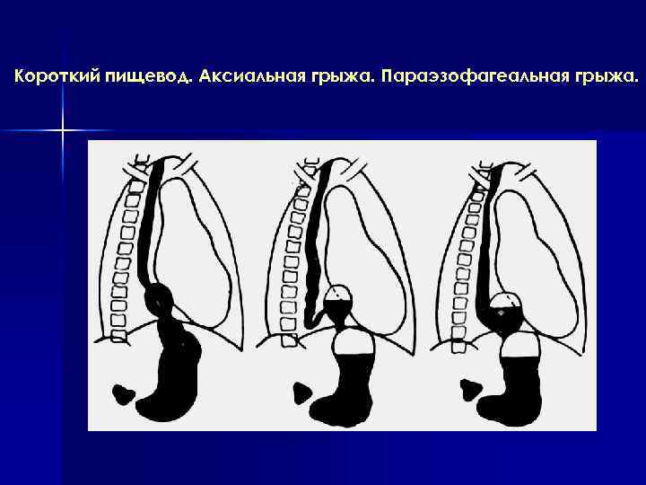 Короткий пищевод. Аксиальная грыжа. Параэзофагеальная грыжа. 