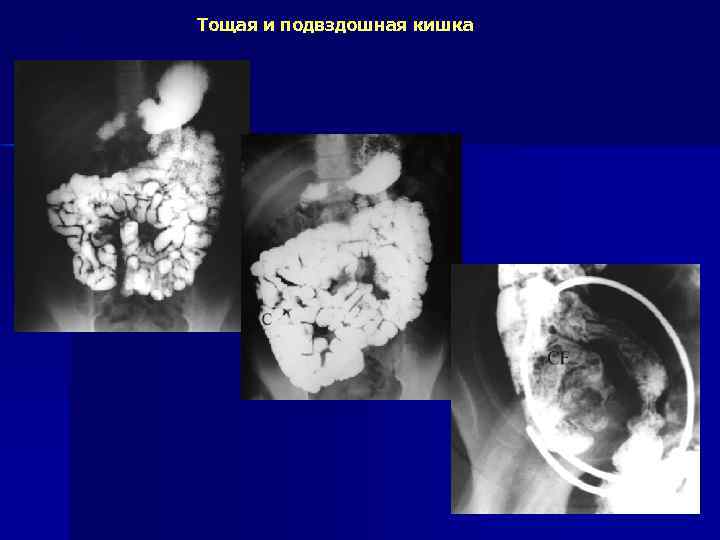 Тощая и подвздошная кишка 
