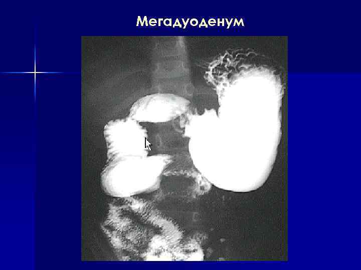 Мегадуоденум 