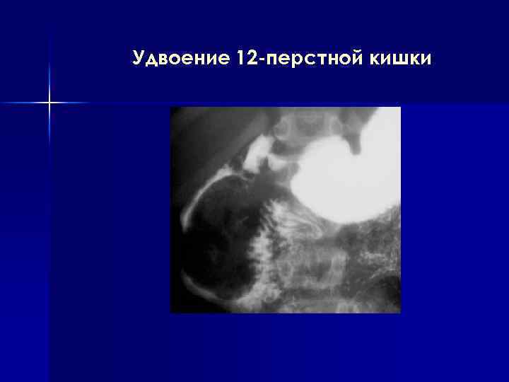 Удвоение 12 -перстной кишки 