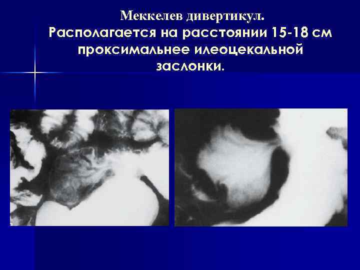 Меккелев дивертикул. Располагается на расстоянии 15 -18 см проксимальнее илеоцекальной заслонки. 