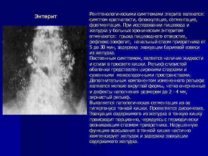 Энтерит Рентгенологическими симптомами этерита являются: симптом крапчатости, флоккуляция, сегментация, фрагментация. При исследовании пищевода и