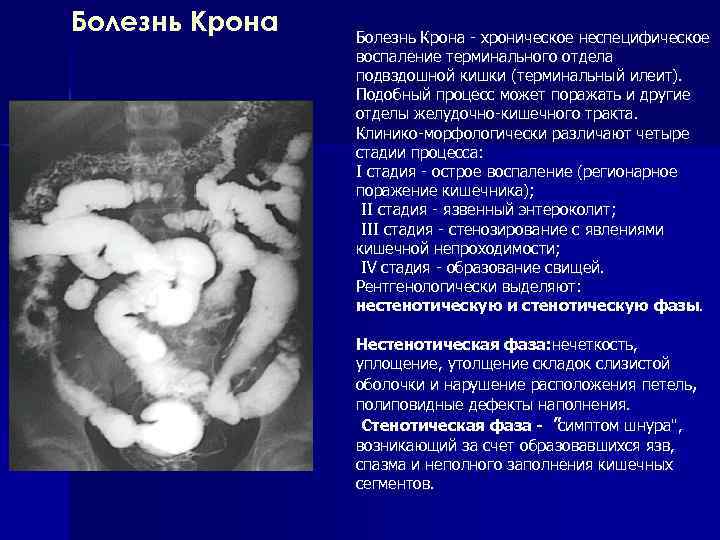 Болезнь Крона хроническое неспецифическое воспаление терминального отдела подвздошной кишки (терминальный илеит). Подобный процесс может