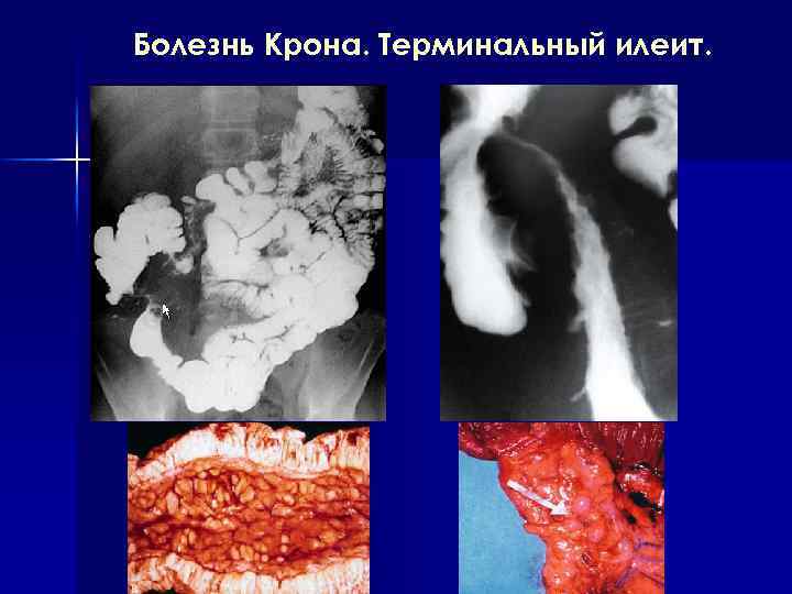 Болезнь Крона. Терминальный илеит. 