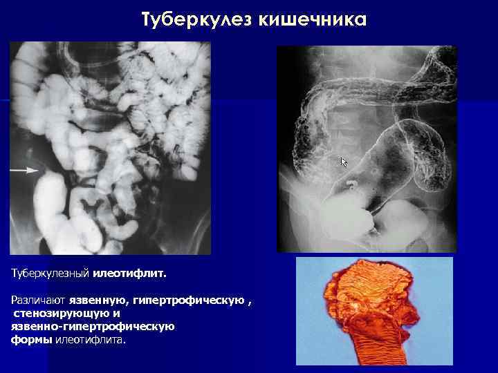 Туберкулез кишечника картинки