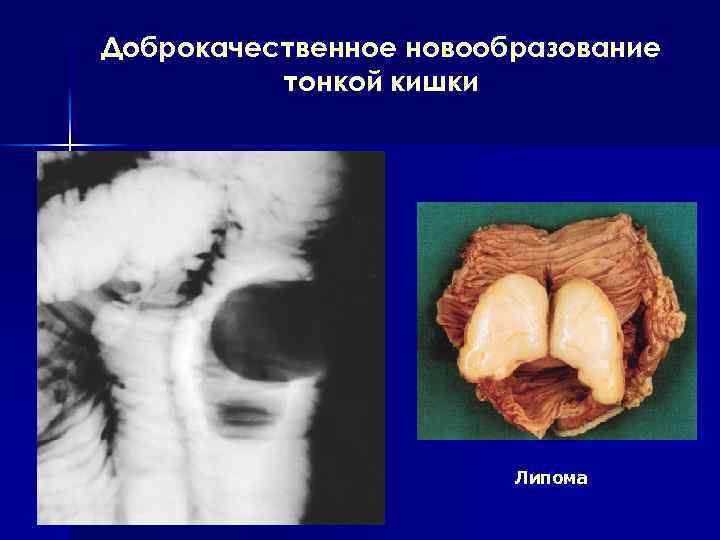 Доброкачественное новообразование тонкой кишки Липома 