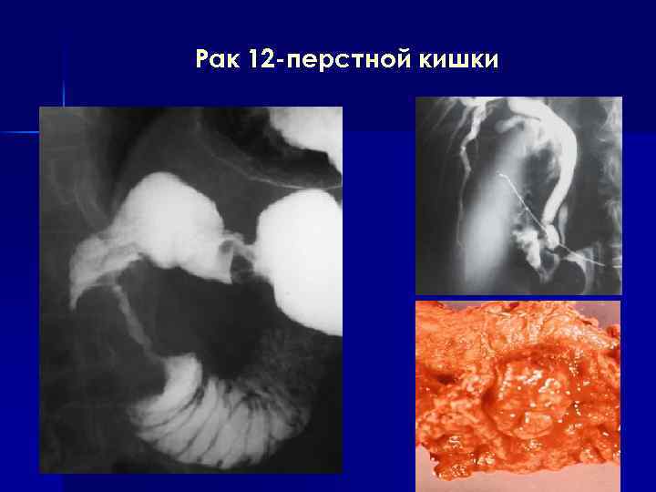 Моторная функция тонкой кишки