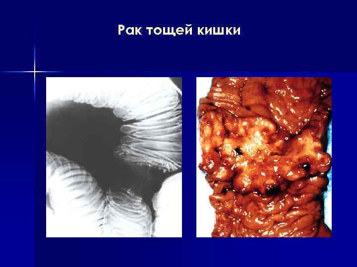 Рак тощей кишки 