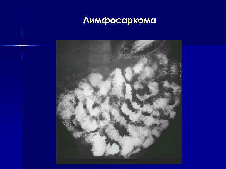 Лимфосаркома 