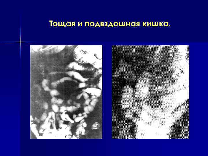 Тощая и подвздошная кишка. 