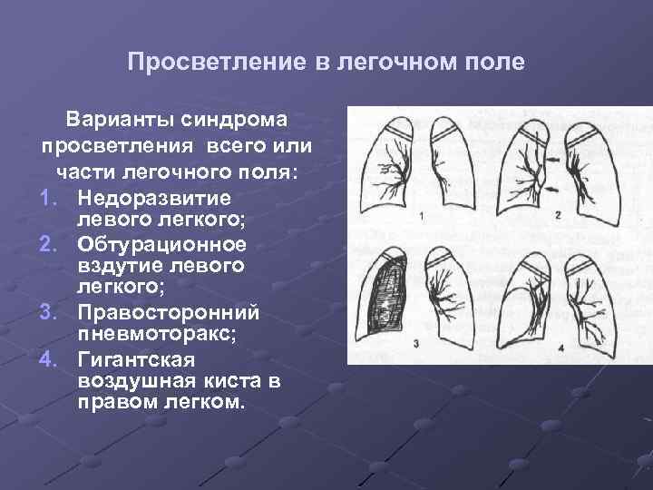 Синдромы легких. Рентгенологические синдромы просветления легочной ткани. Синдром диффузного просветления легочной ткани. Синдром обширного просветления легочного поля. Просветление легочного рисунка.