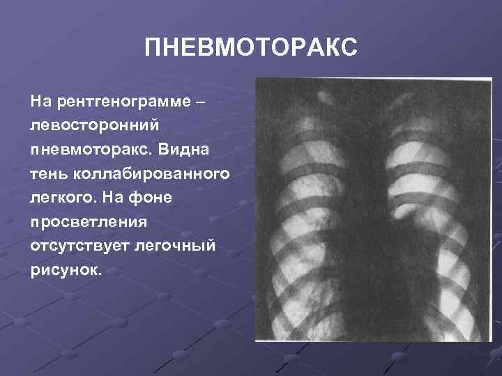 Рентген картина пневмоторакса