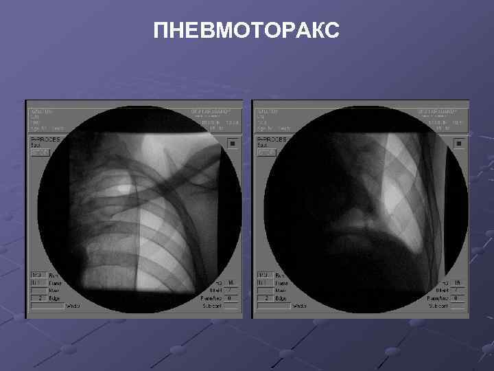 ПНЕВМОТОРАКС 