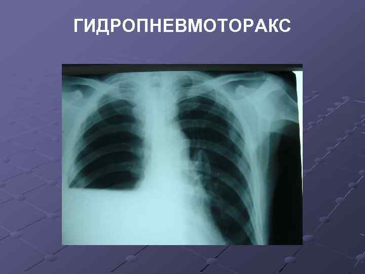 ГИДРОПНЕВМОТОРАКС 