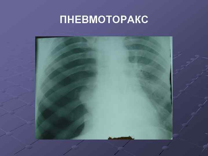 ПНЕВМОТОРАКС 