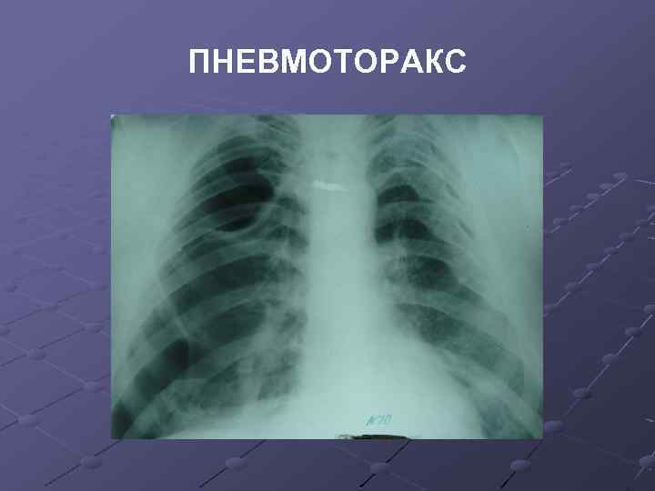 ПНЕВМОТОРАКС 