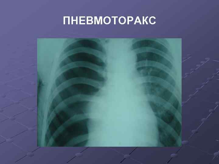 ПНЕВМОТОРАКС 