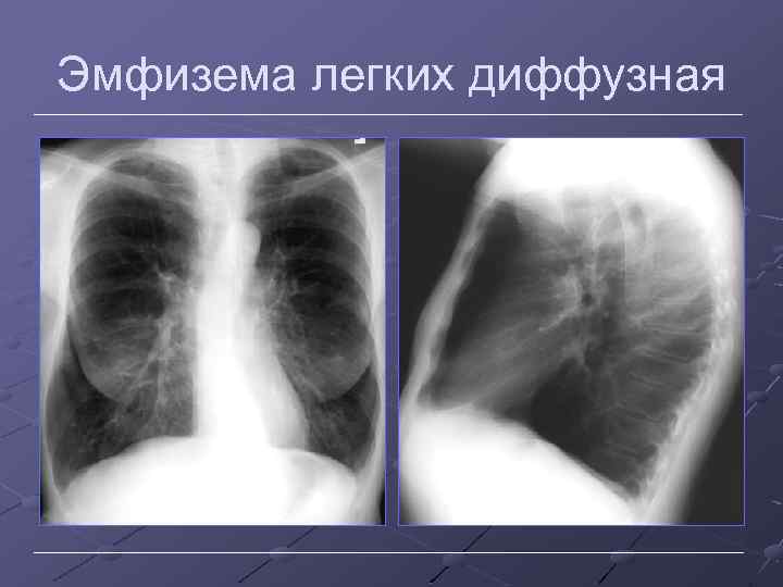 Эмфизема легких диффузная 