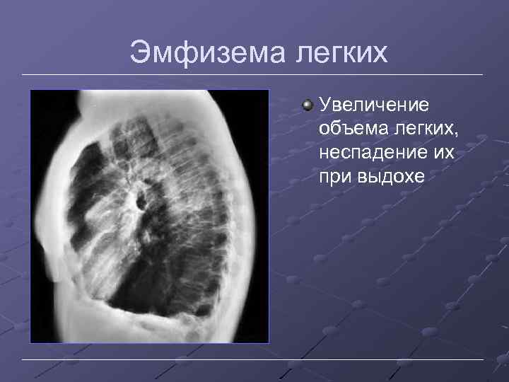 Эмфизема легких Увеличение объема легких, неспадение их при выдохе 