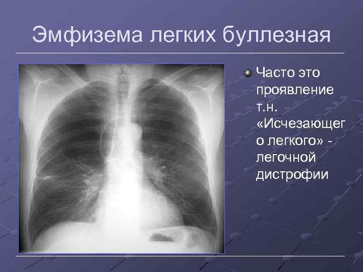 Эмфизема легких буллезная Часто это проявление т. н. «Исчезающег о легкого» легочной дистрофии 