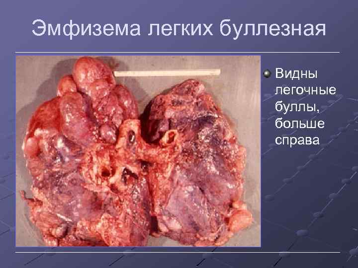 Эмфизема легких буллезная Видны легочные буллы, больше справа 