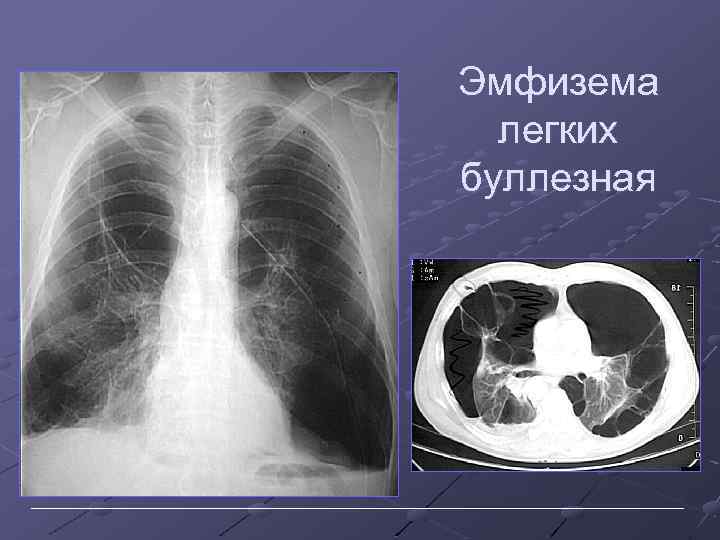 Эмфизема легких буллезная 