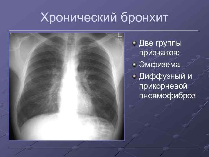 Хронический бронхит Две группы признаков: Эмфизема Диффузный и прикорневой пневмофиброз 