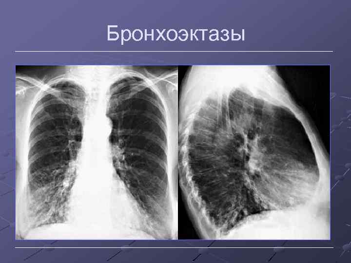 Бронхоэктазы 