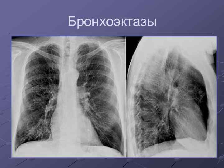 Бронхоэктазы 